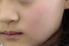 おたふくかぜ(流行性耳下腺炎)